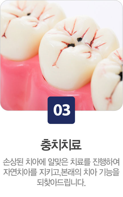 충치치료