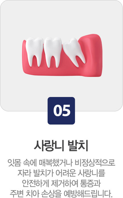 사랑니 발치