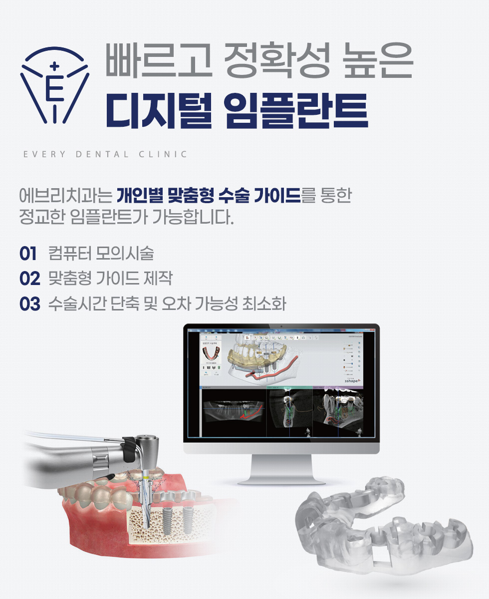 빠르고 정확성 높은 디지털 임플란트