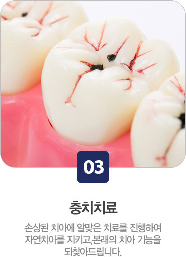 충치치료