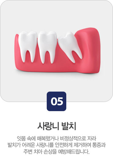 사랑니 발치